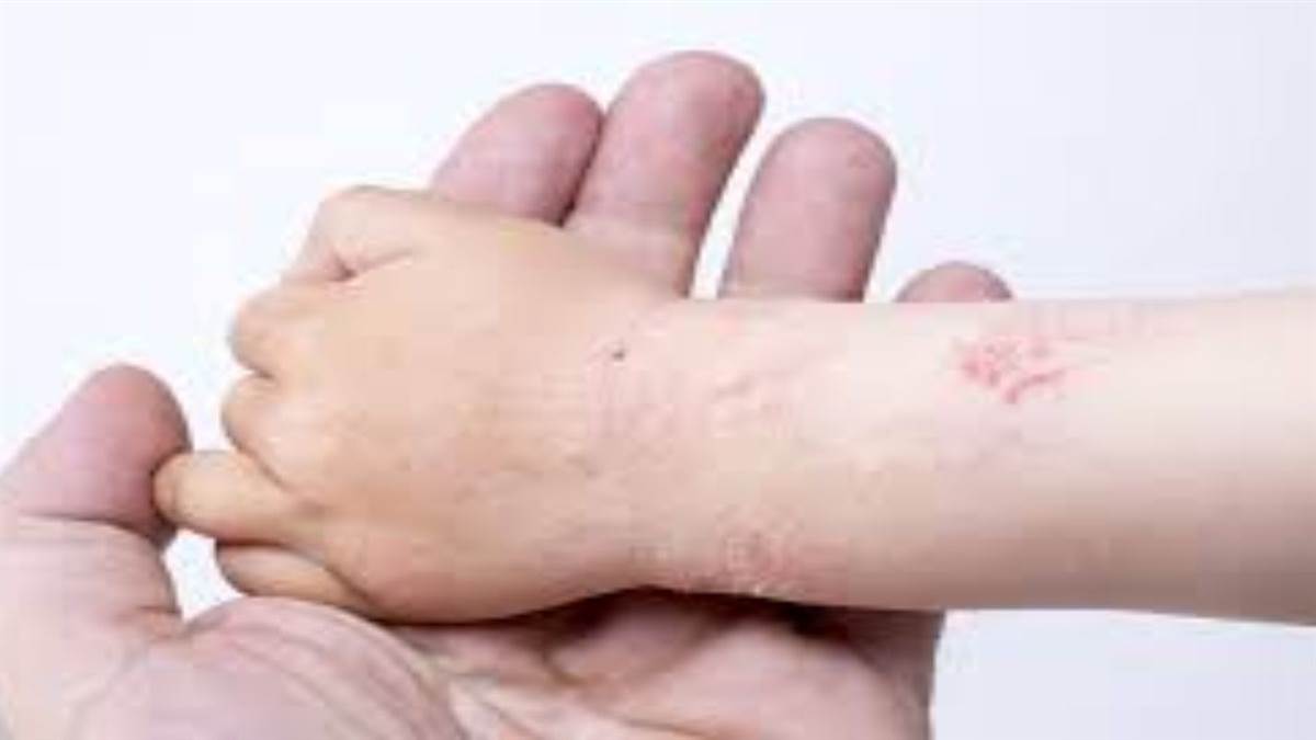 Skin problems in Winter: ठंड में बढ़ती हैं त्वचा संबंधी परेशानियां, केयर करने से रहती हैं बीमारियां दूर