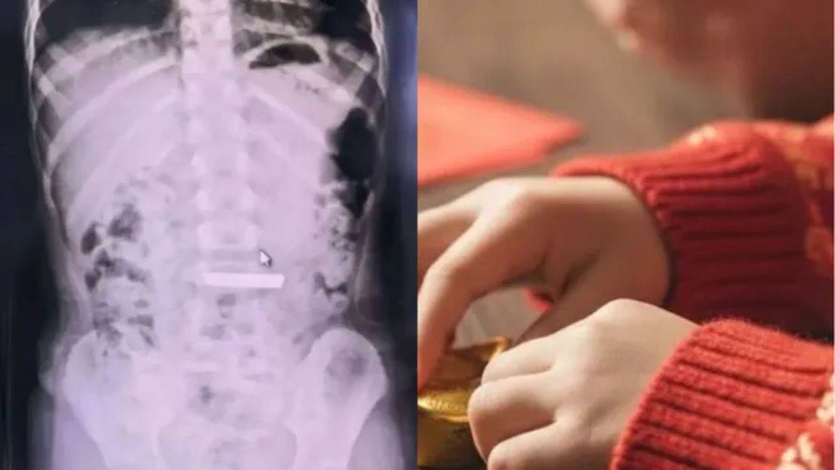 चीन में खेल-खेल में मौत के करीब पहुंच गई बच्ची, निगल गई 50 ग्राम सोने का बिस्किट, सर्जरी के बाद बचाई जान