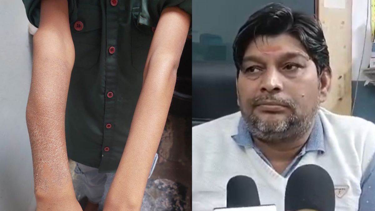 Whatsapp पर 'इलाज' पड़ा भारी... फोन पर एक्स-रे दिखा ली राय और कर दिया प्लास्टर, अब मासूम सूजन और दर्द से बेहाल