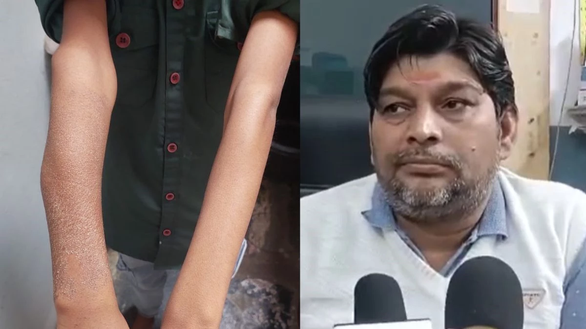 Whatsapp पर 'इलाज' पड़ा भारी... फोन पर एक्स-रे दिखा ली राय और कर दिया प्लास्टर, अब मासूम सूजन और दर्द से बेहाल