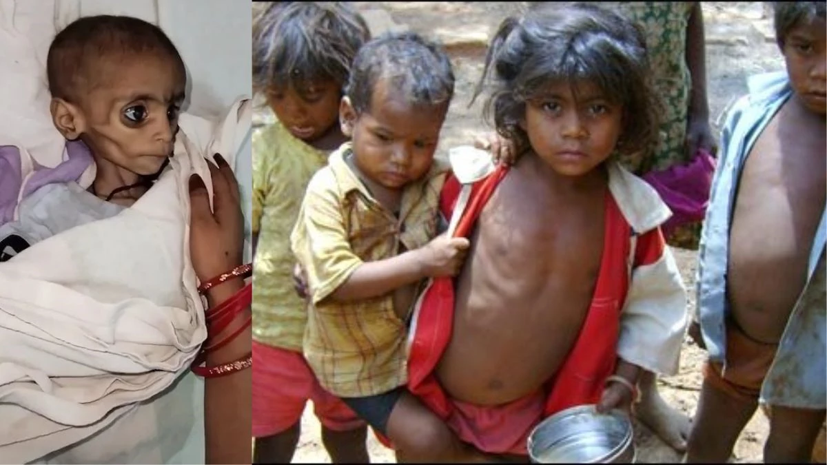 आठ रुपये में कैसे दूर होगा कुपोषण? MP में आठ साल से नहीं बढ़ी दरें; 33 फीसदी बच्चों का वजन बेहद कम