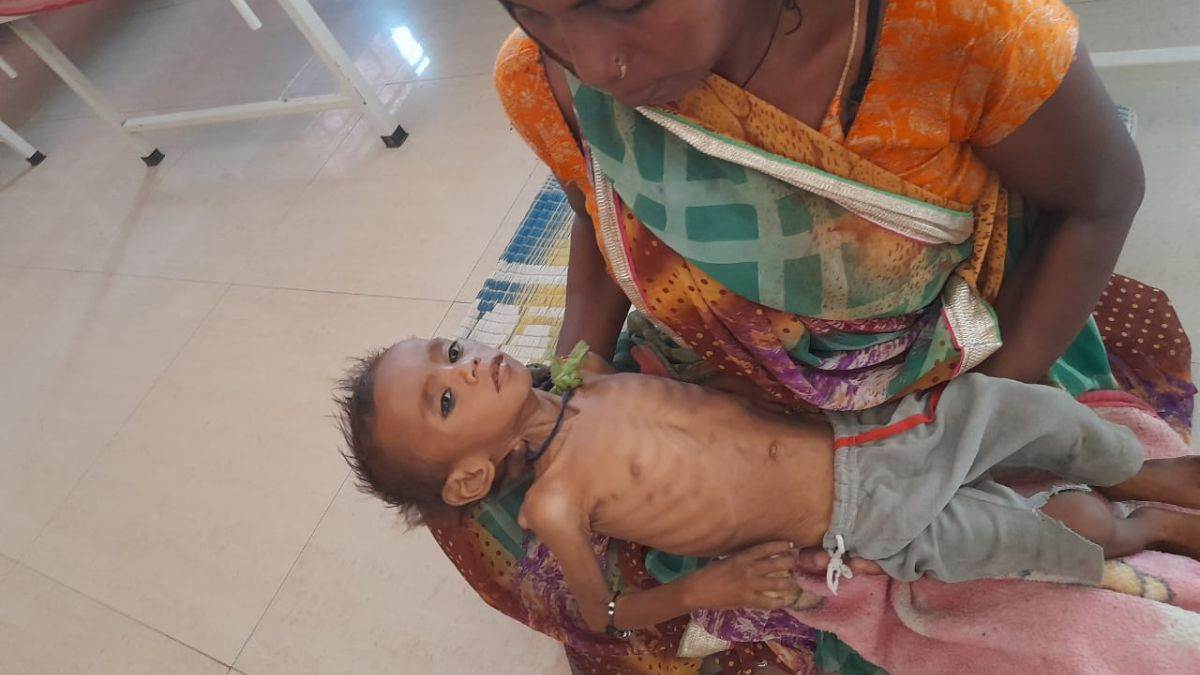 MP News:  जीवन मृत्यु से जूझ रहा  गंभीर कुपोषण का शिकार मनीष आदिवासी, शरीर में एक ग्राम बचा हे हीमोग्लोबिन