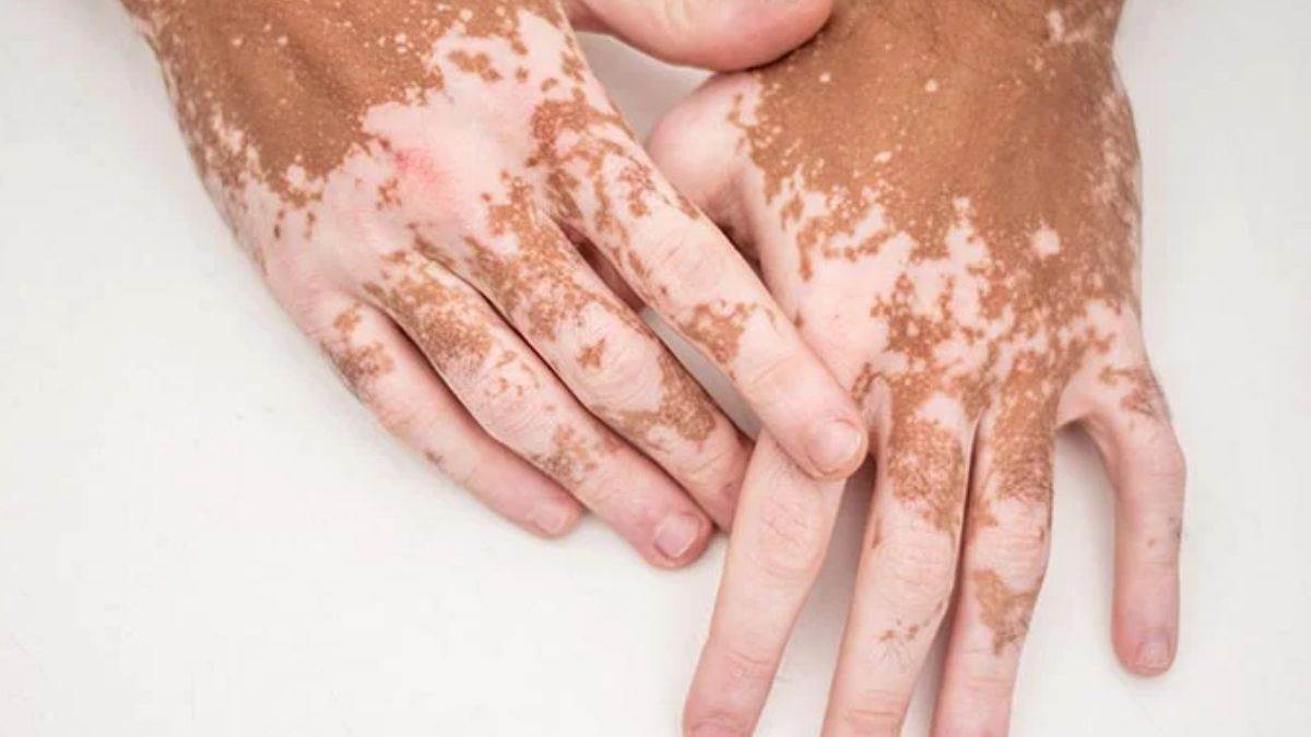 World Vitiligo Day 2023: ऑटोइम्यून त्वचा रोग है सफेद दाग, जानें इसके कारण व बचाव के उपाय