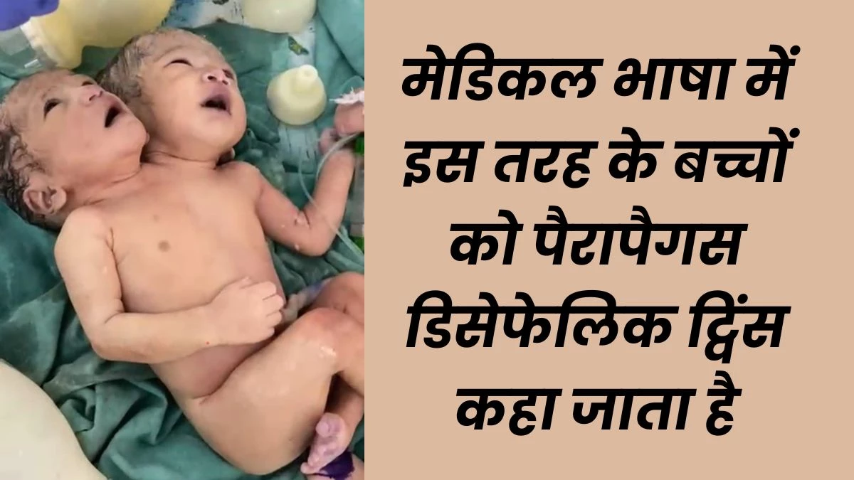 इंदौर के अस्पताल में हुआ दो सिर और एक धड़ वाली बच्ची का जन्म