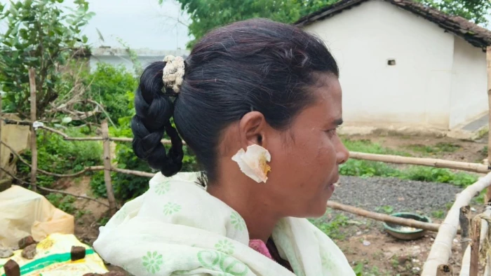 मंडला में आवारा कुत्ते हिंसक, बच्चे और विद्यार्थी भी चपेट में; घर में घुसकर कान में काटा