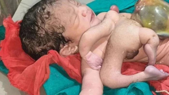 खजुराहो से एयरलिफ्ट कर जबलपुर मेडिकल काॅलेज लाया गया, 4 हाथ और 4 पैर वाले नवजात की स्थिति गंभीर
