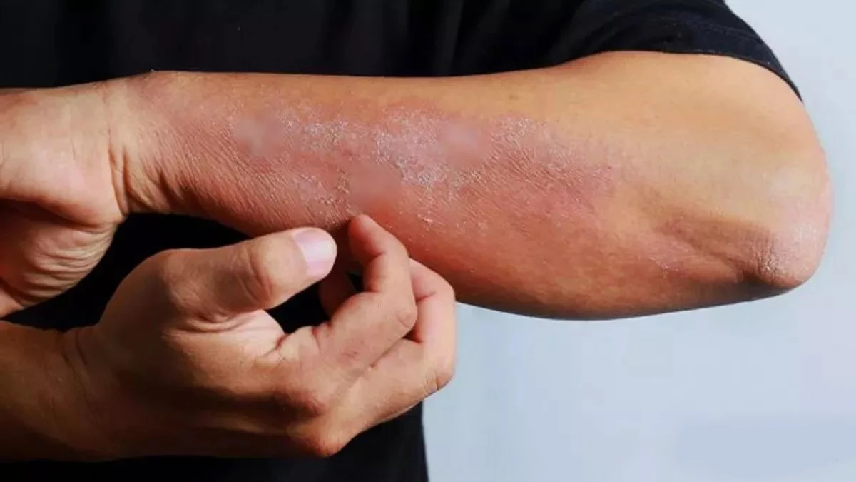 कमजोर इम्युनिटी पर हावी हो रहा हर्पीज जोस्टर, कोरोना से रिकवर मरीज भी चपेट में