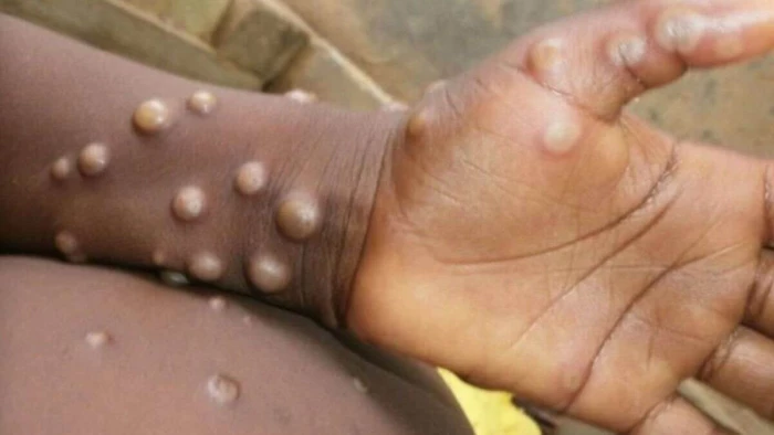 जानवरों से भी MPox फैलने का खतरा... बुखार, सिरदर्द सहित 5 लक्षण दिखें तो हो जाएं सावधान