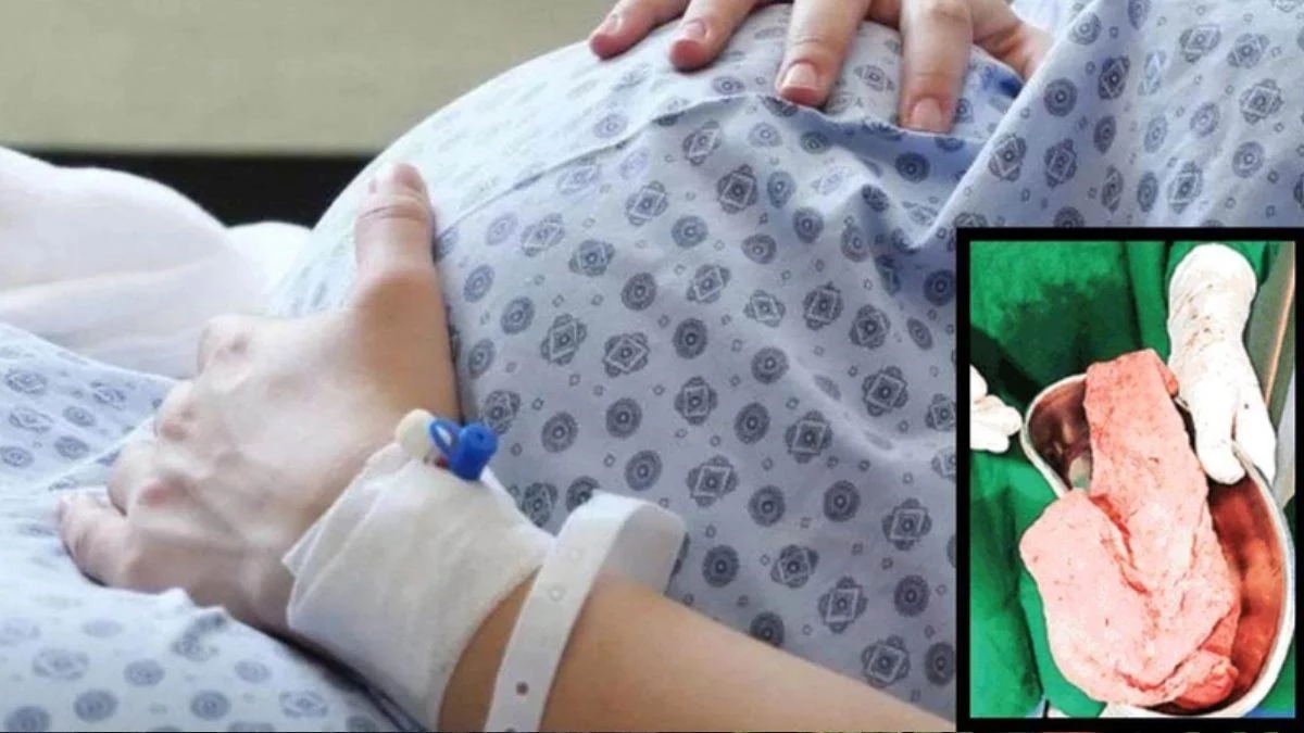 छिंदवाड़ा में प्रसव के दौरान बड़ी लापरवाही, महिला के शरीर में छूटा कपड़ा , इंफेक्शन से हालत नाजुक