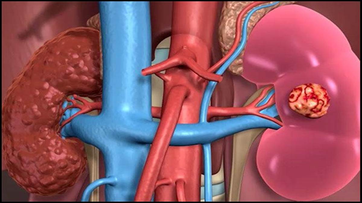 Health Tips : हाथ-पैरों से जुड़े ये लक्षण बताते हैं आपको है किडनी की समस्या  - Health Tips These symptoms related to hands and feet tell that you have  kidney problem