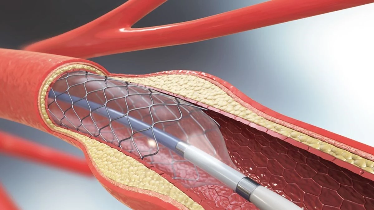 Angioplasty: हार्ट ही नहीं, अब गले और हाथ-पैर की नसों की हो रही एंजियोप्लास्टी, इंदौर में फ्री सुविधा