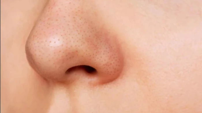 नाक के इलाज में लापरवाही बरतने पर डॉक्टर पर लगा जुर्माना, मरीज ने मांगा 49.56 लाख रुपए का मुआवजा