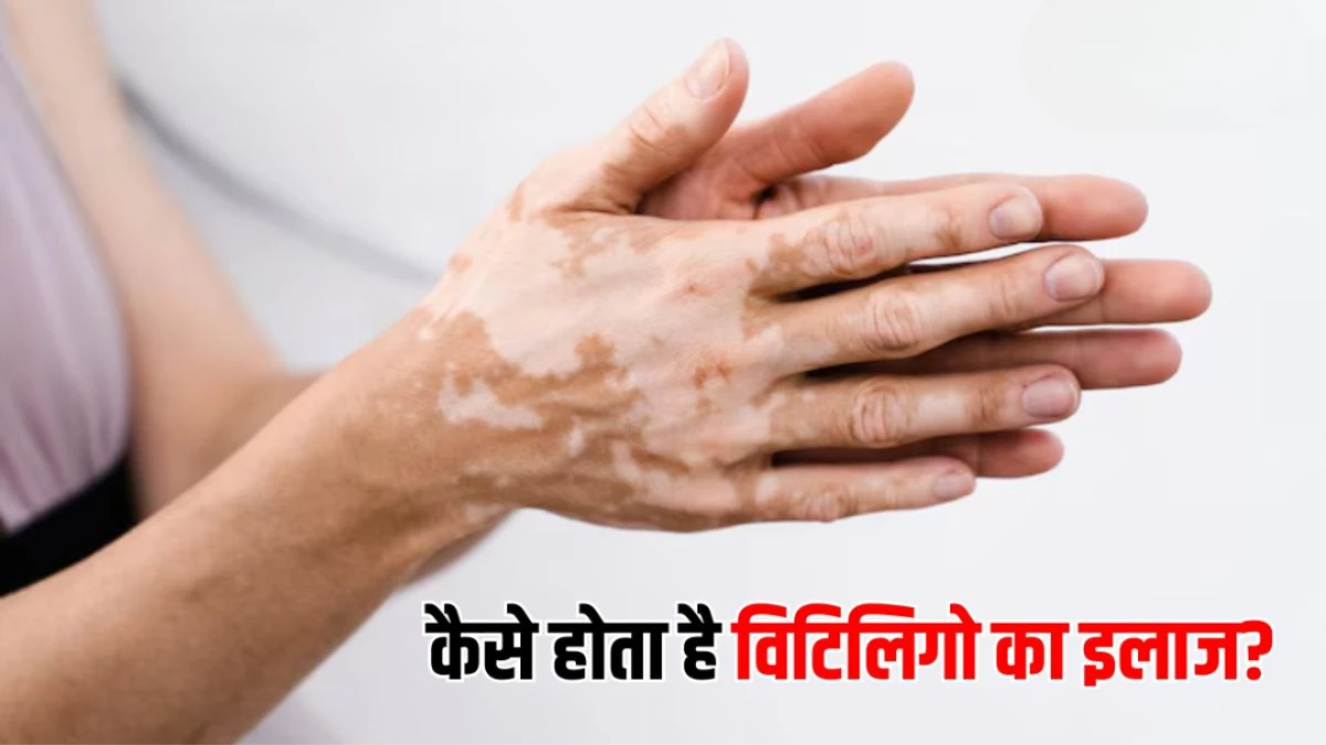 Vitiligo Disease: किन लोगों में बढ़ सकता है सफेद दाग का खतरा? जानें इस समस्या के शुरुआती संकेत