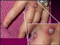 Monkeypox Virus Outbreak: कपड़े व टॉवेल बिल्कुल न करें शेयर, इन चीजों से फैलता है मंकीपॉक्स संक्रमण