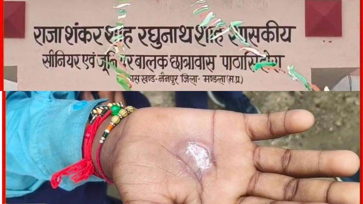 मंडला के छात्रावास में पैसे चोरी का आरोप लगाकर छात्रों के हाथ जलाए, बेल्ट से पीटने वाला अधीक्षक निलंबित; 8 छात्र निष्कासित