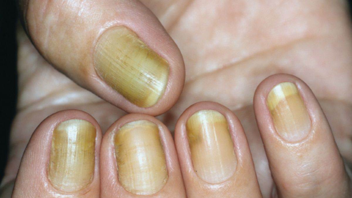 Pitted Nails as Sign of Psoriasis