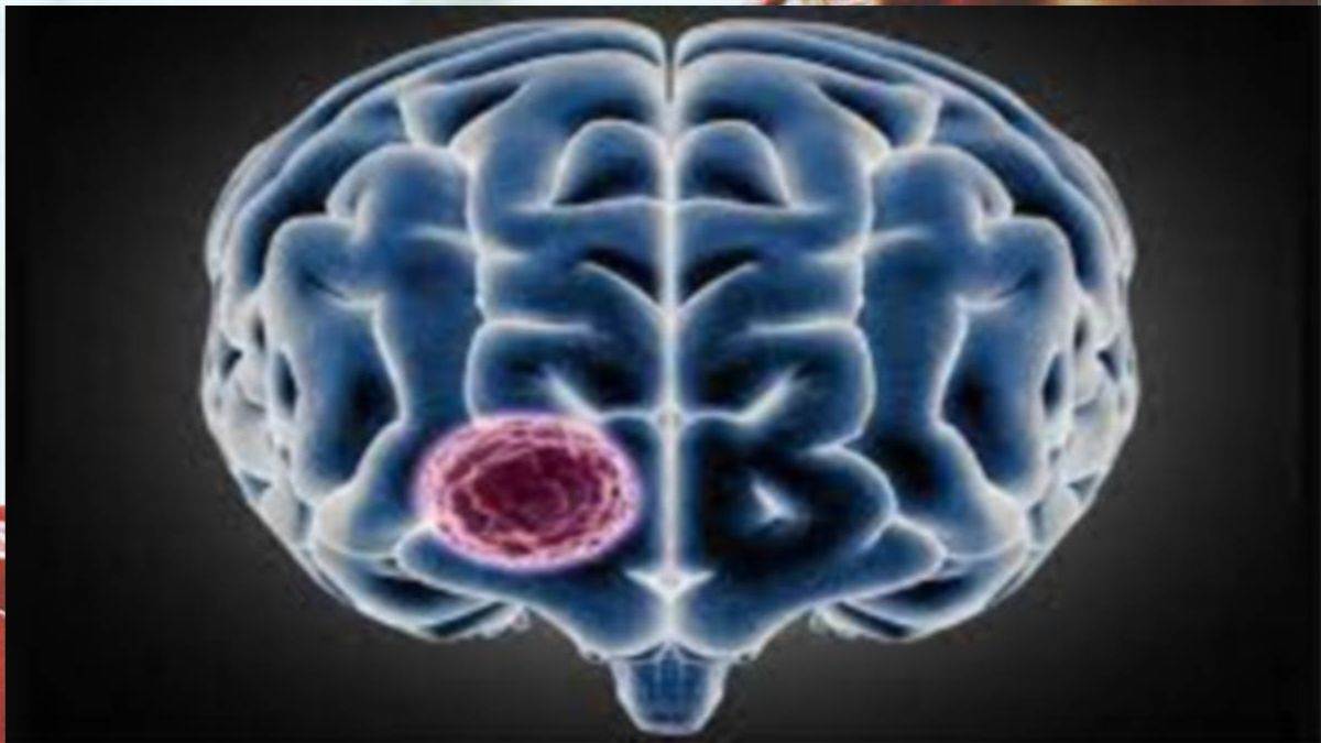 MP Information: AI आधारित एप दो मिनट में बताएगा सिर में किस जगह है ट्यूमर, भोपाल की छात्रा ने किया कमाल