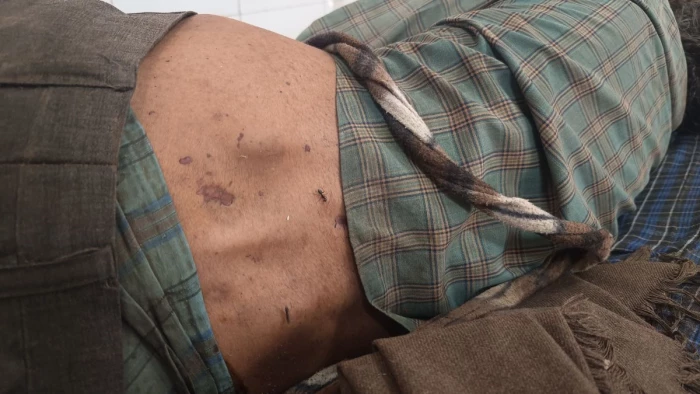 मुरैना में अमानवीयता की हदें पारः तीन दिन तक नहीं मिला इलाज, मौत के बाद शव में लगे चींटे तब चेकअप को आए डॉक्टर