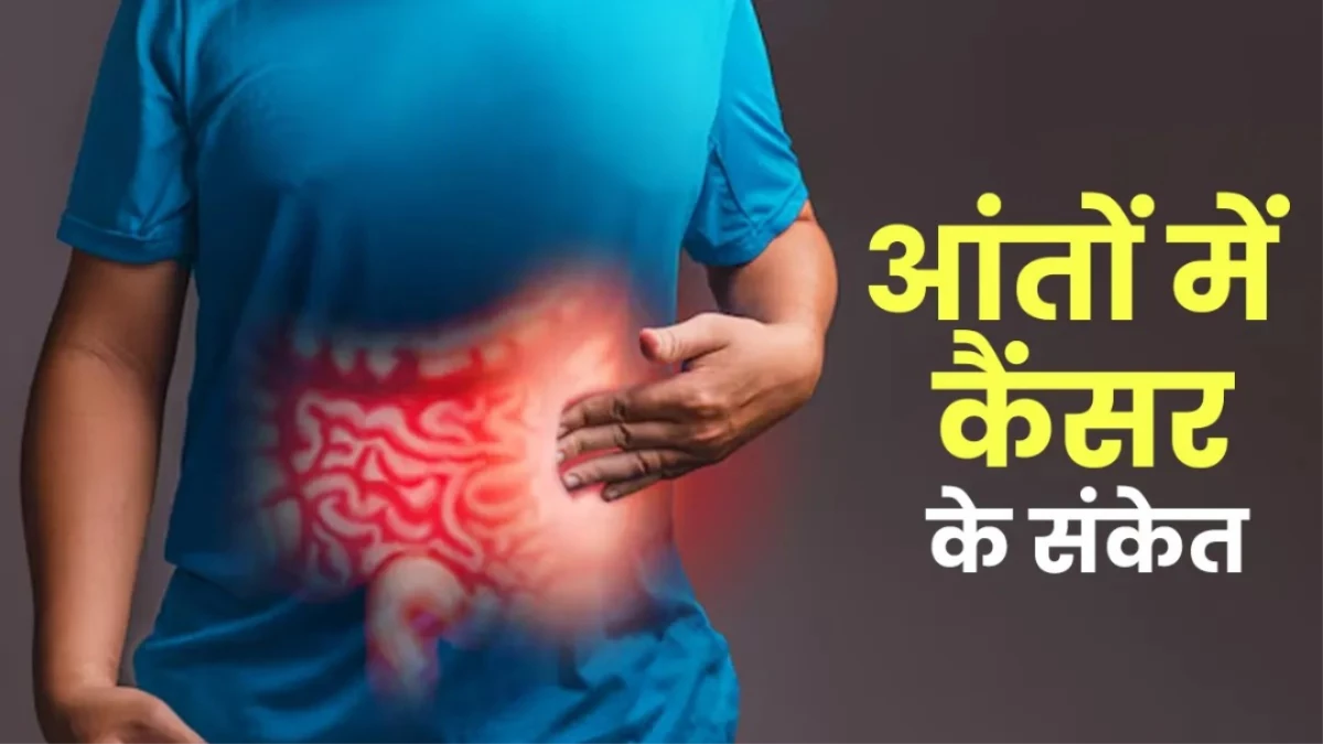 Colon Cancer के इन 5 संकेतों को भूलकर भी न करें नजरअंदाज, वरना बॉडी में घर बना लेगी यह जानलेवा बीमारी