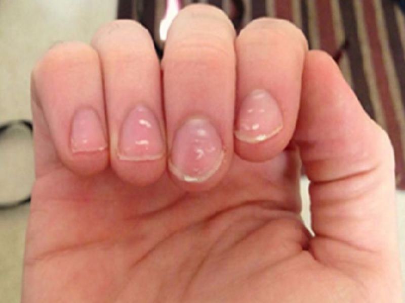 White Spots On Nails: Myths Vs Facts | Vedical