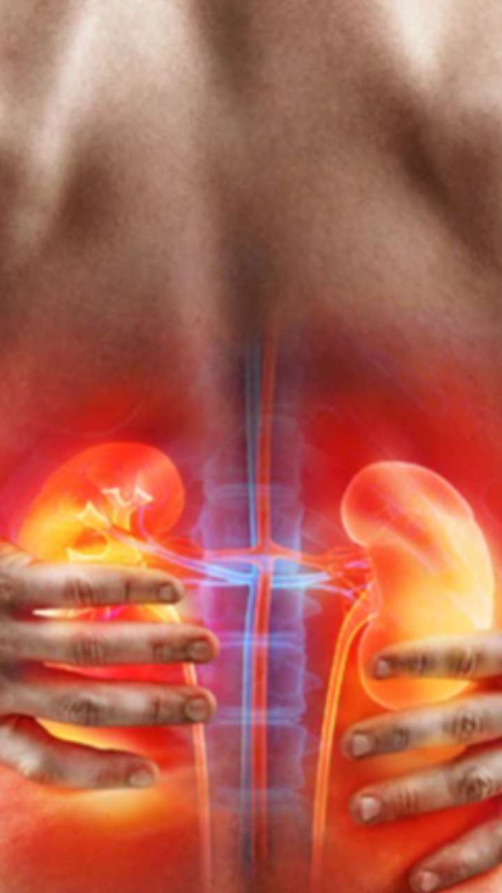 Kidney Stones: ये चीजें बिल्कुल न खाएं वरना बढ़ जाएगी पथरी की समस्या