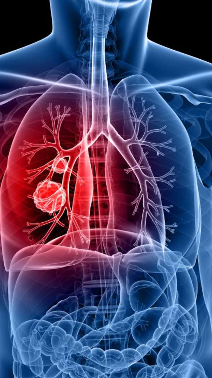Lung Cancer: शरीर में 5 बदलाव हो सकते हैं इस घातक बीमारी के लक्षण